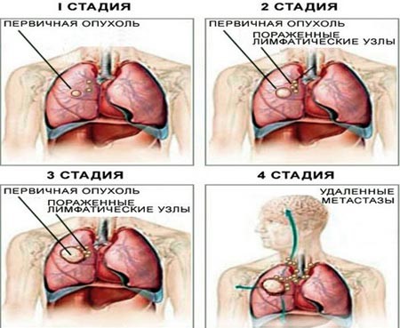 Свистящие хрипы — причины, обследование и лечение в Астрахани | Симптомы | Клиника «Консилиум»